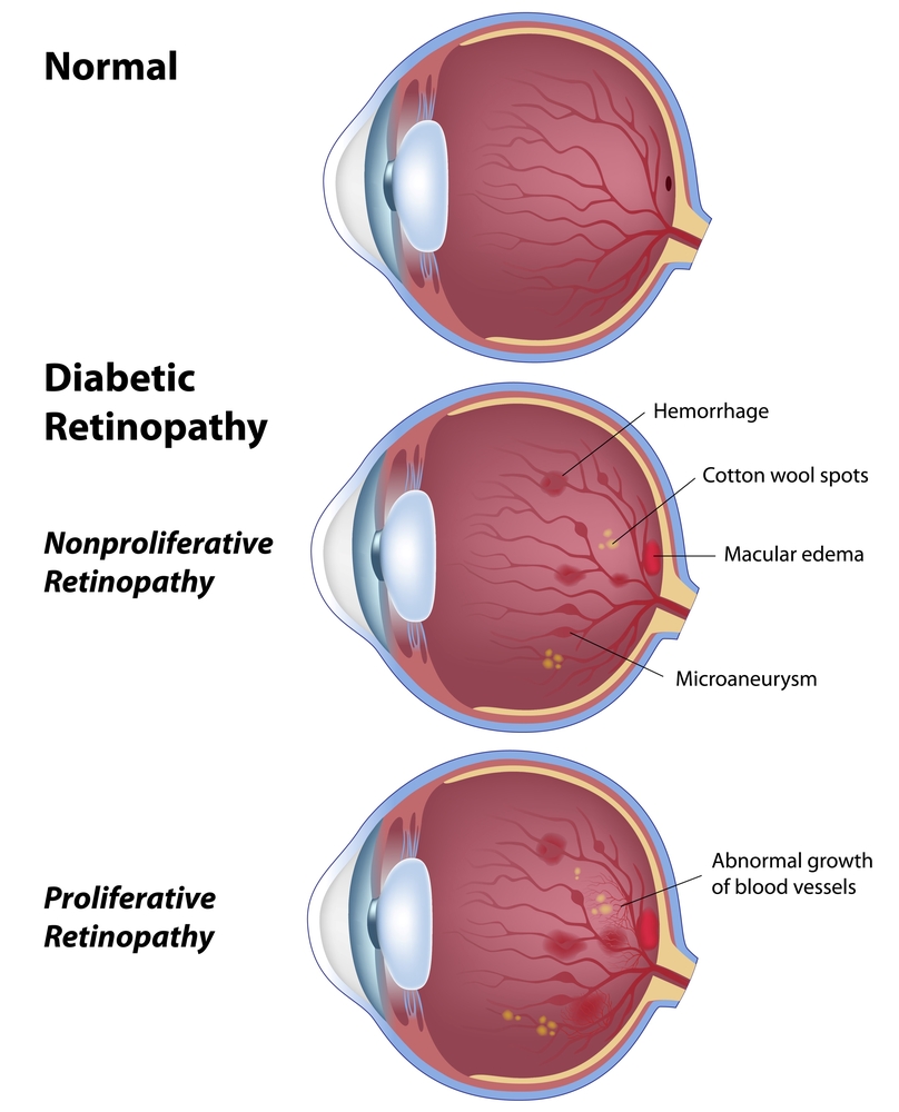 Diabetic eye diagram