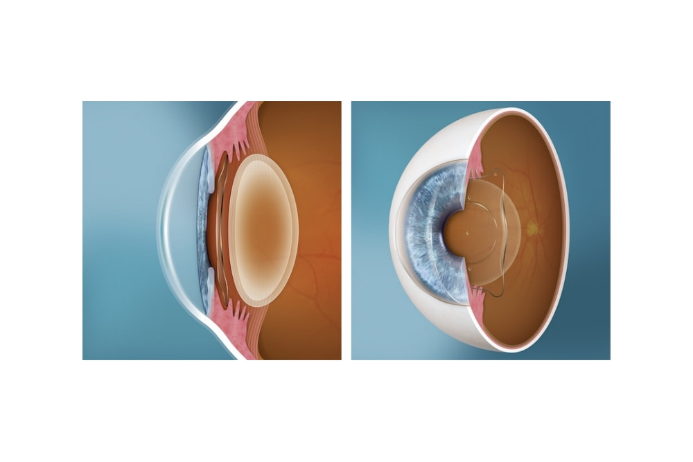 Graphic depicting the EVO icl procedure on an eyeball